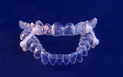 : Close-up of an oral appliance for treating sleep apnea in Wayland, MA