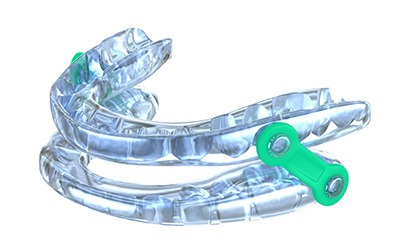 Close-up of oral appliance used for sleep apnea treatment