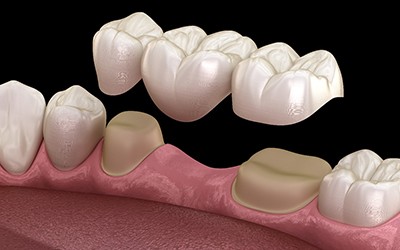 Illustration of dental bridge in Wayland, MA being placed