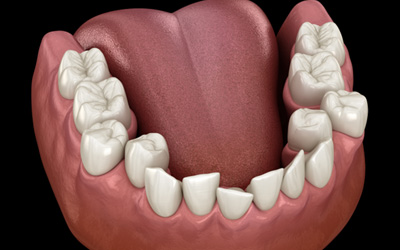 Illustration of teeth in the lower arch crowded together