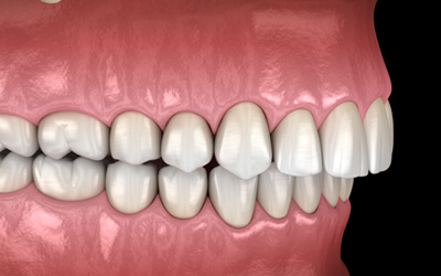 Illustration of an overbite viewed from the side