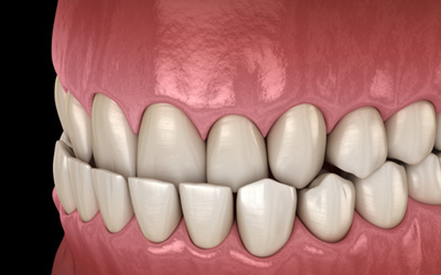 Illustration of an underbite viewed from the front