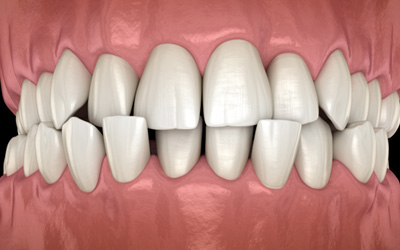 Illustration of a crossbite viewed from the front