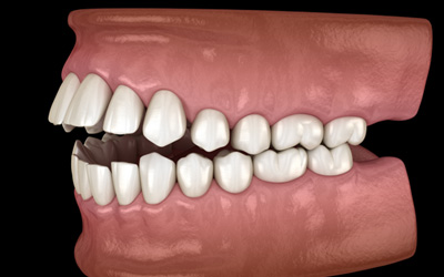 Illustration of side view of open bite