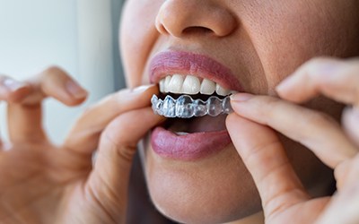 Woman putting clear aligner over her teeth