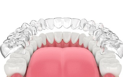 Illustration of Invisalign in Wayland, MA for lower arch