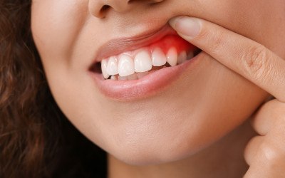 Woman pulling up lip to show signs of gum disease in Wayland, MA