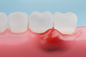 Close up of inflamed gums around teeth