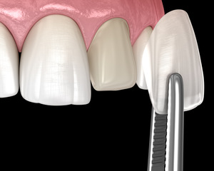 Illustration of veneer being placed on a prepared tooth